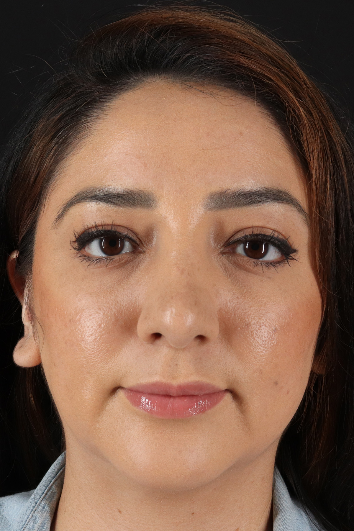 Rhinoplasty Before & After Patient #3115