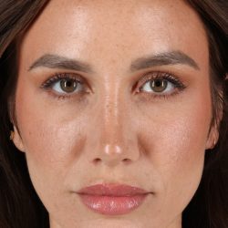 Rhinoplasty Before & After Patient #3137