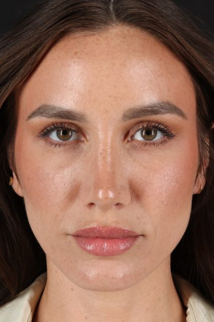 Rhinoplasty Before & After Patient #3137