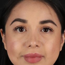Chin Implant Before & After Patient #1626
