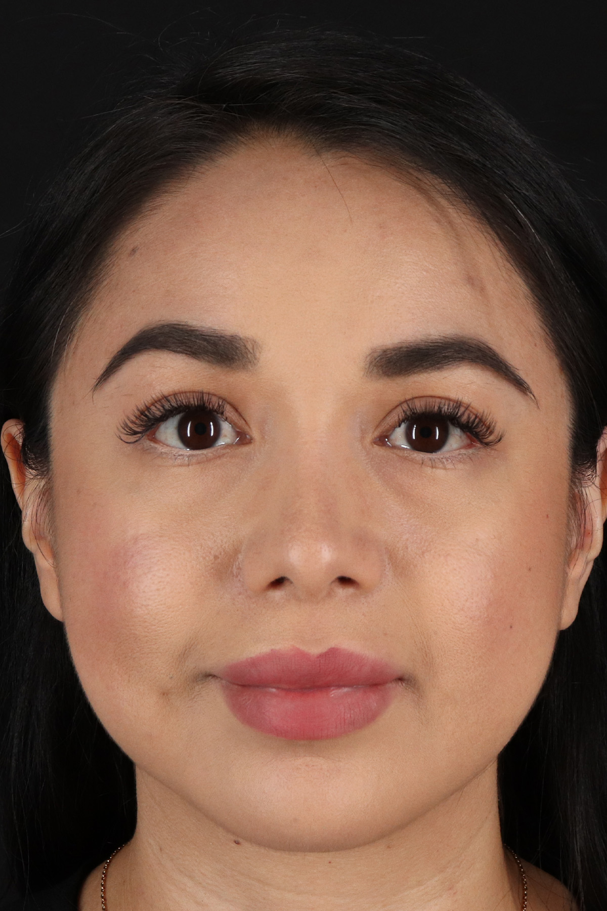 Chin Implant Before & After Patient #1626