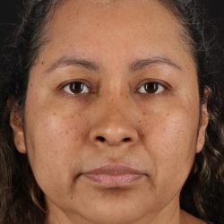 Rhinoplasty Before & After Patient #3225