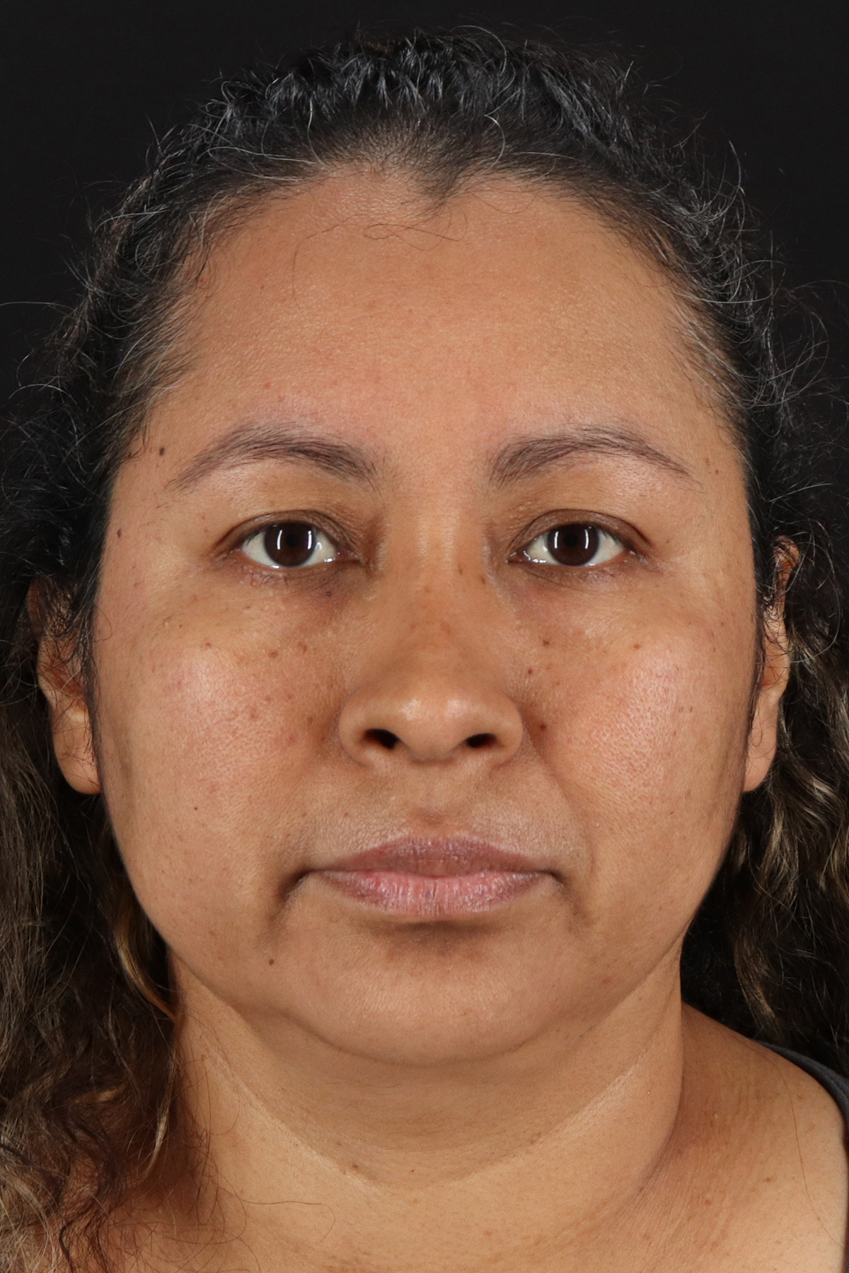 Rhinoplasty Before & After Patient #3225