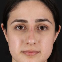 Liquid Rhinoplasty Before & After Patient #2188