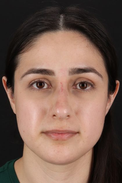 Liquid Rhinoplasty Before & After Patient #2188