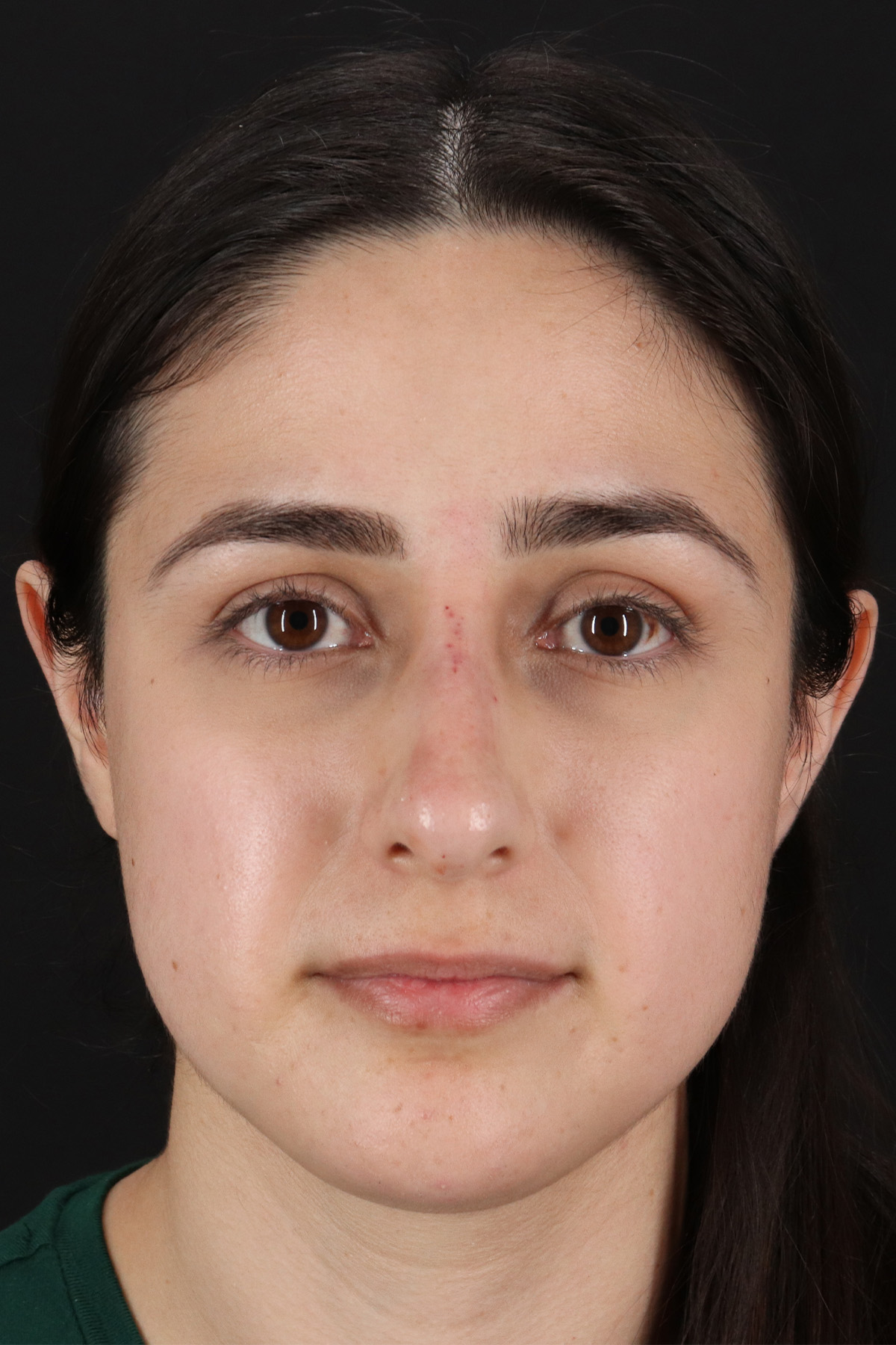 Liquid Rhinoplasty Before & After Patient #2188