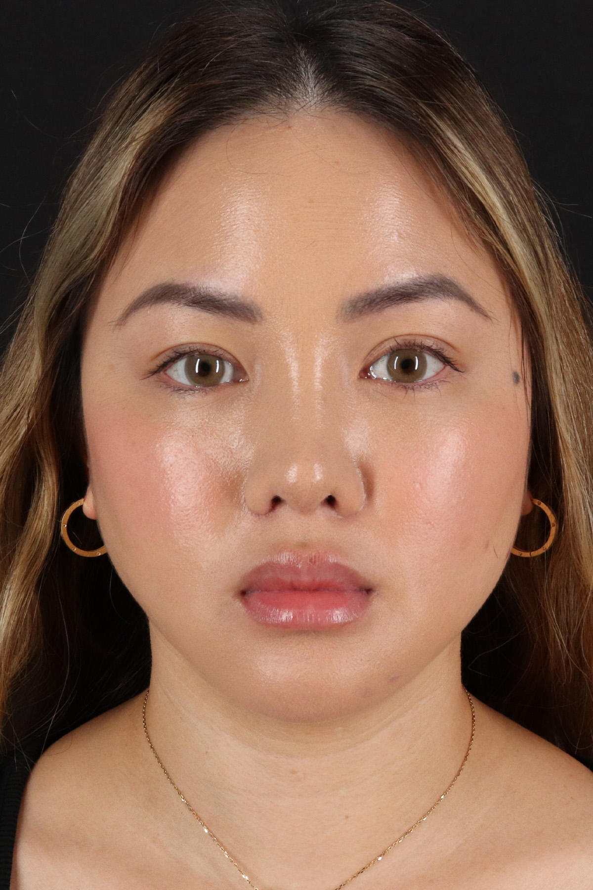 Chin Implant Before & After Patient #1507