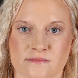 Rhinoplasty Before & After Patient #3126