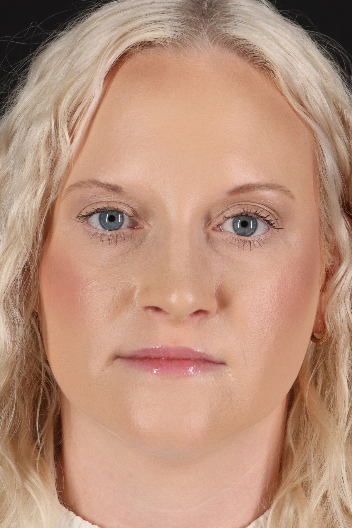 Rhinoplasty Before & After Patient #3126