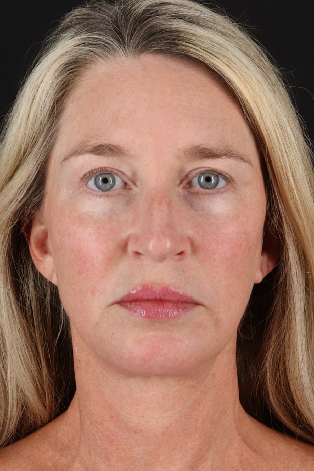 Neck Lift Before & After Patient #2441