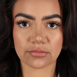 Rhinoplasty Before & After Patient #3192