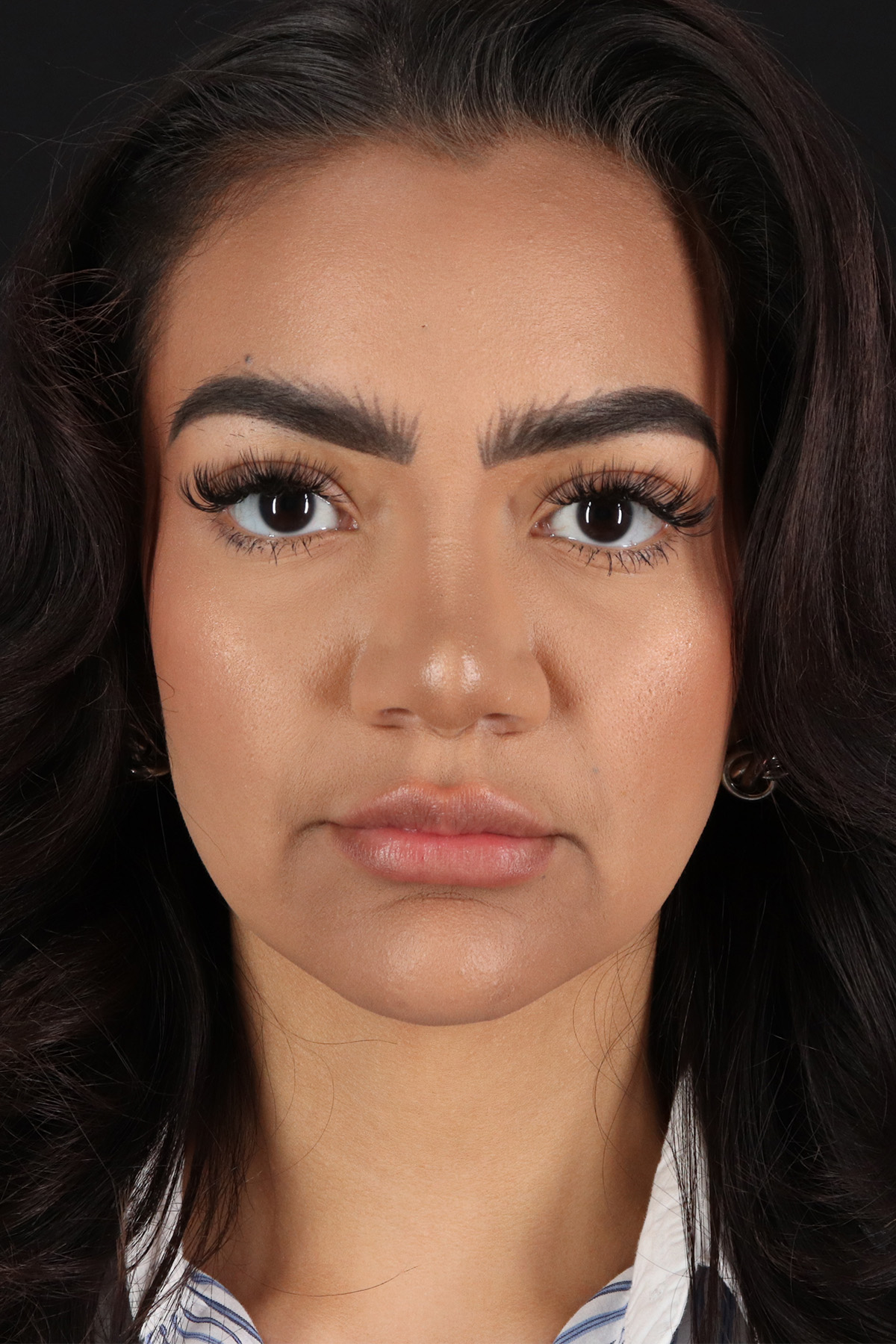 Rhinoplasty Before & After Patient #3192