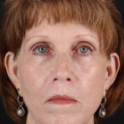 Lip Lift Before & After Patient #2155