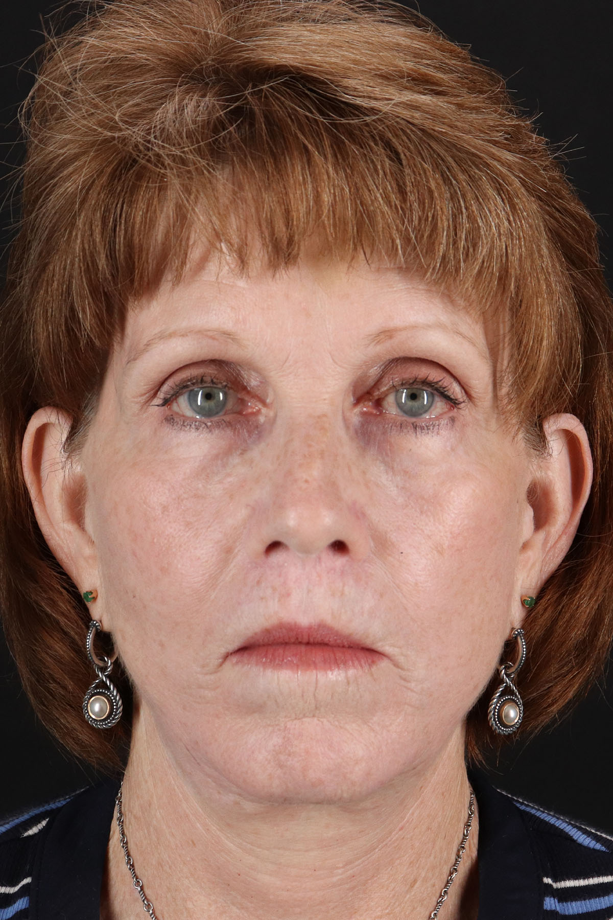 Lip Lift Before & After Patient #2155