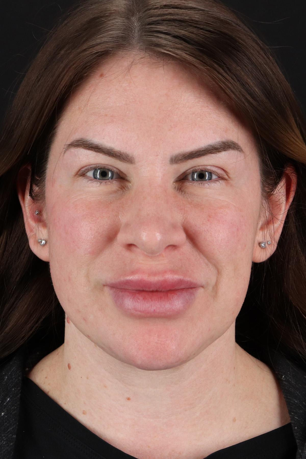 Rhinoplasty Before & After Patient #3093