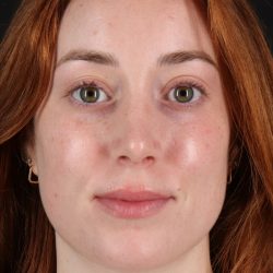 Rhinoplasty Before & After Patient #3170