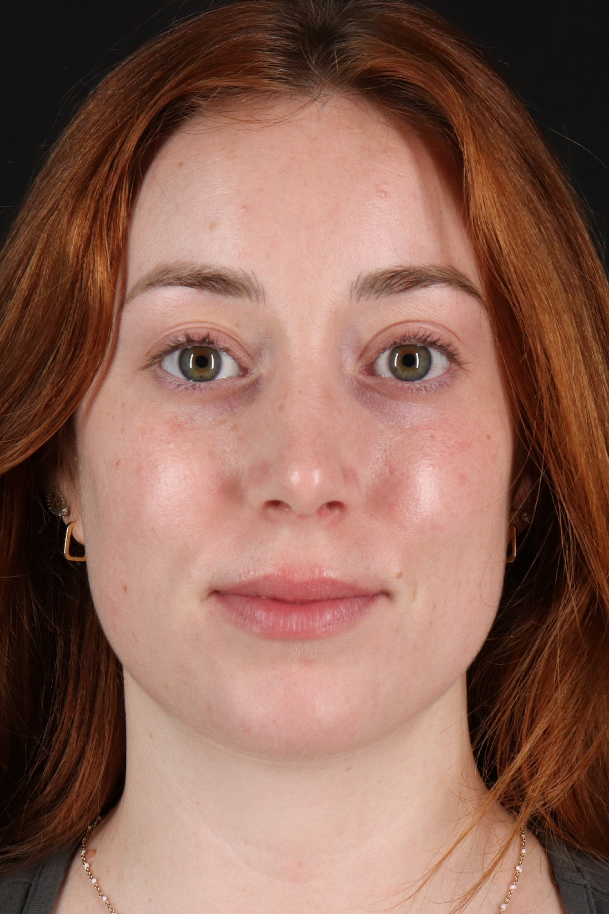 Rhinoplasty Before & After Patient #3170