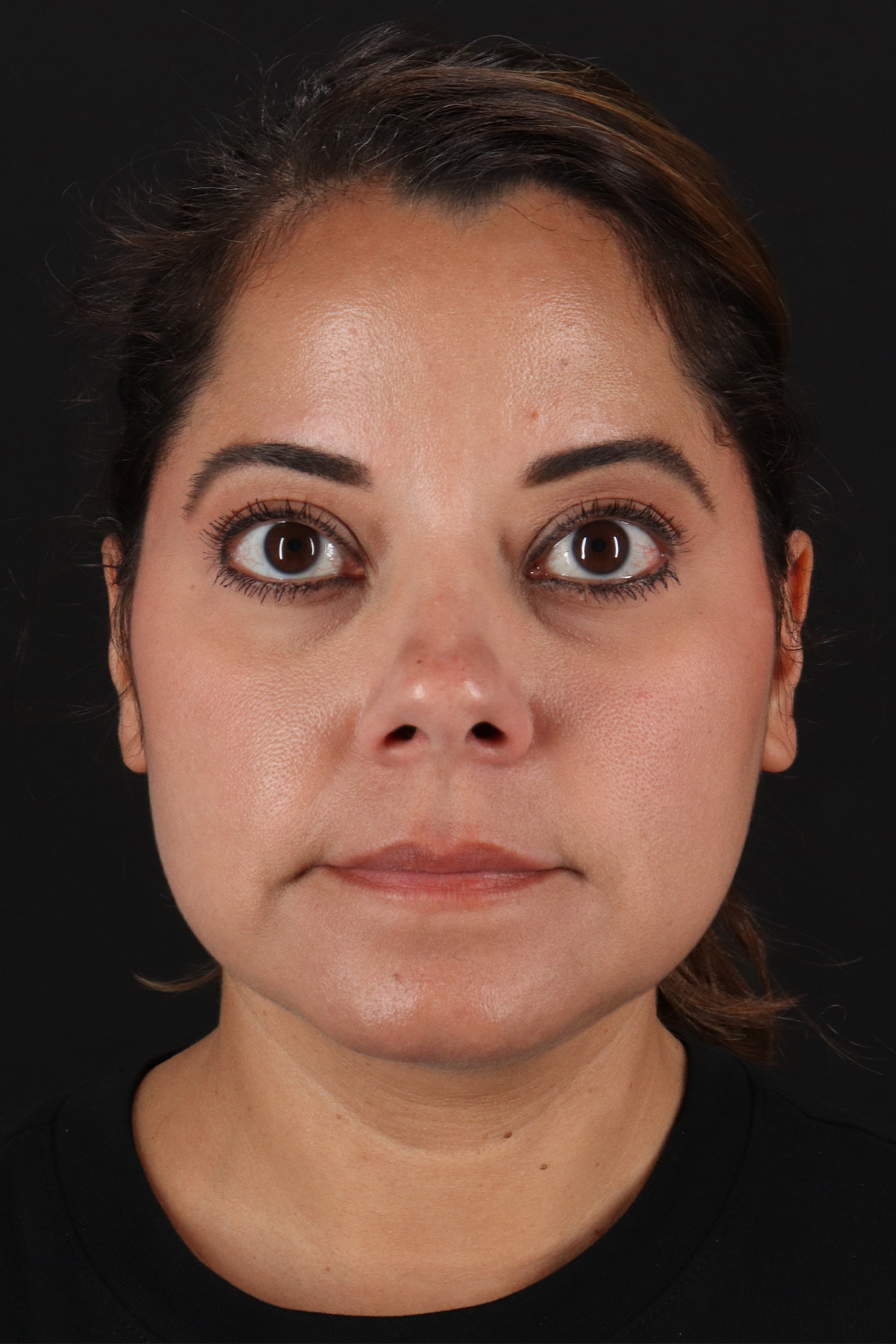 Buccal Fat Pad Before & After Patient #1436