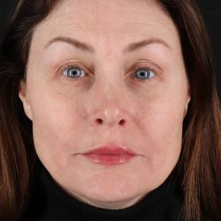 Lip Lift Before & After Patient #2144