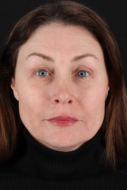 Lip Lift Before & After Patient #2144