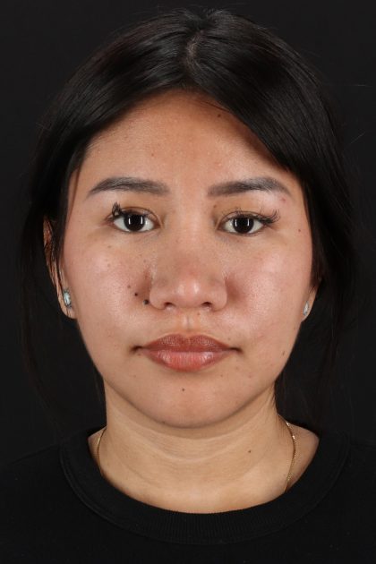Rhinoplasty Before & After Patient #2829