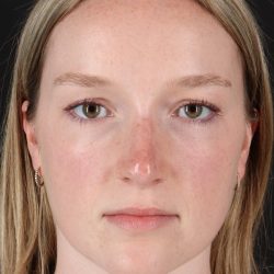 Liquid Rhinoplasty Before & After Patient #2177