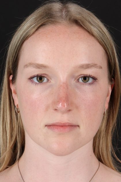 Liquid Rhinoplasty Before & After Patient #2177
