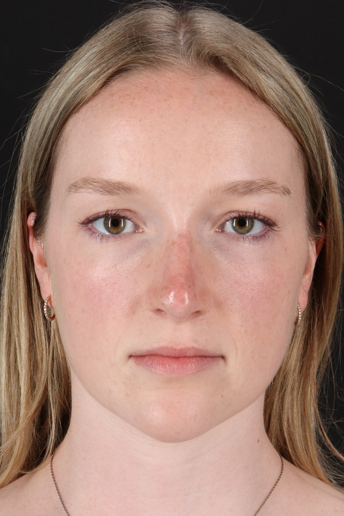 Liquid Rhinoplasty Before & After Patient #2177
