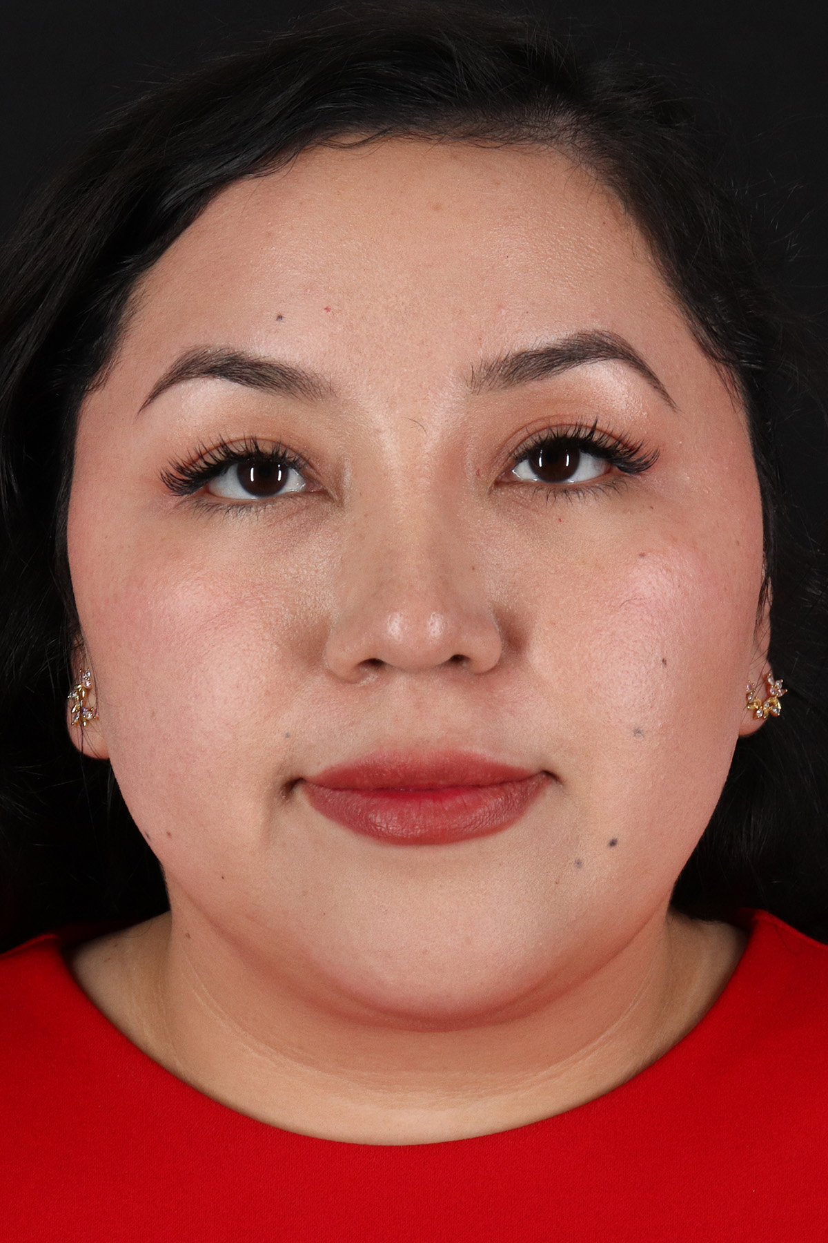 Rhinoplasty Before & After Patient #3060