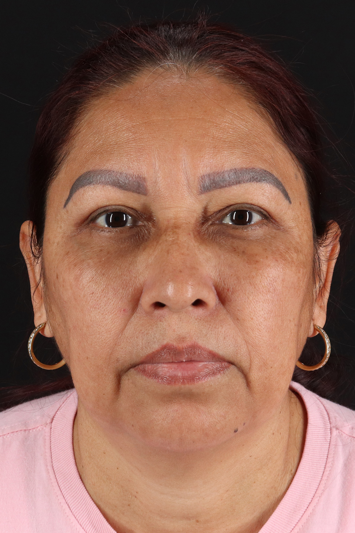 Lower Blepharoplasty Before & After Patient #2321