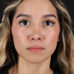 Rhinoplasty Before & After Patient #3302
