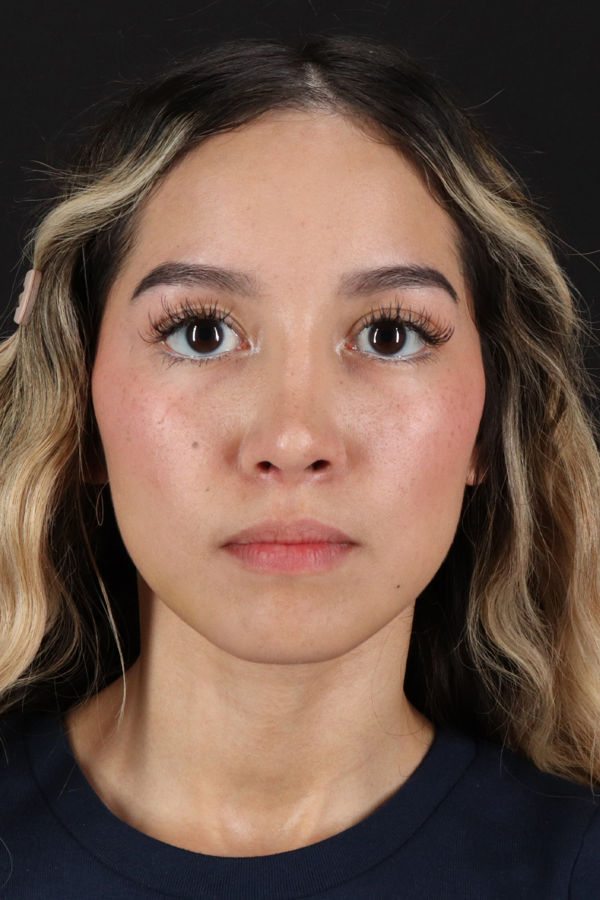 Rhinoplasty Before & After Patient #3302
