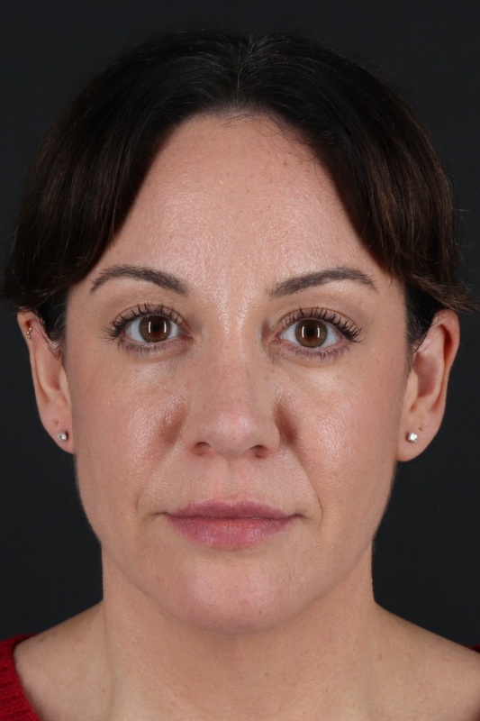 Browlift Before & After Patient #1363