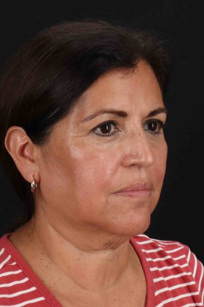 Facelift Before & After Patient #3544
