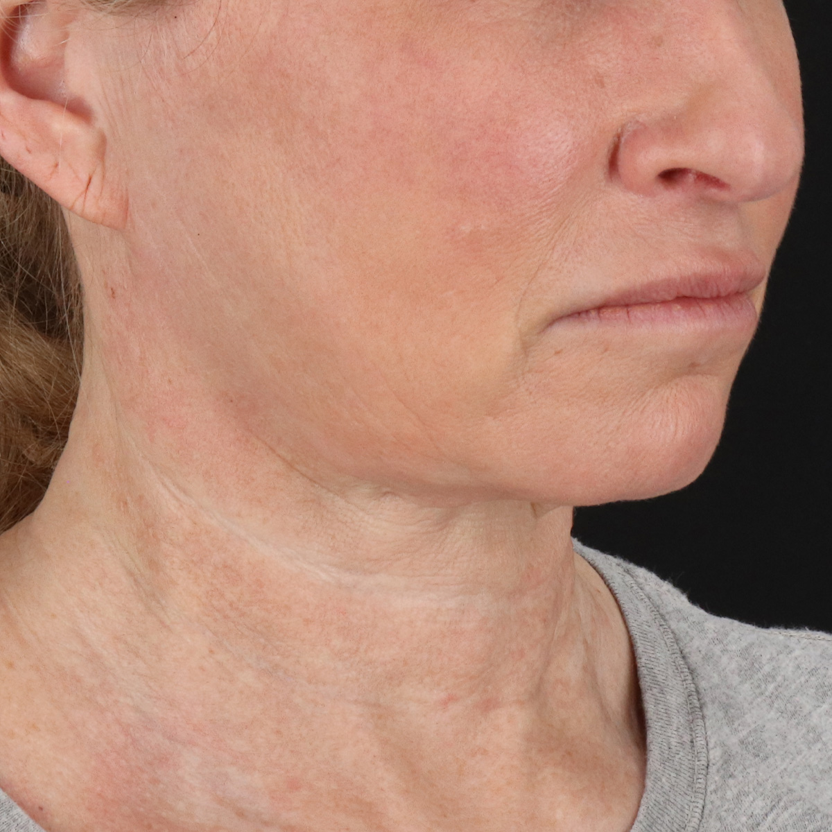 Facelift Before & After Patient #1866
