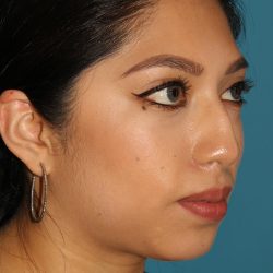 Chin Implant Before & After Patient #1670