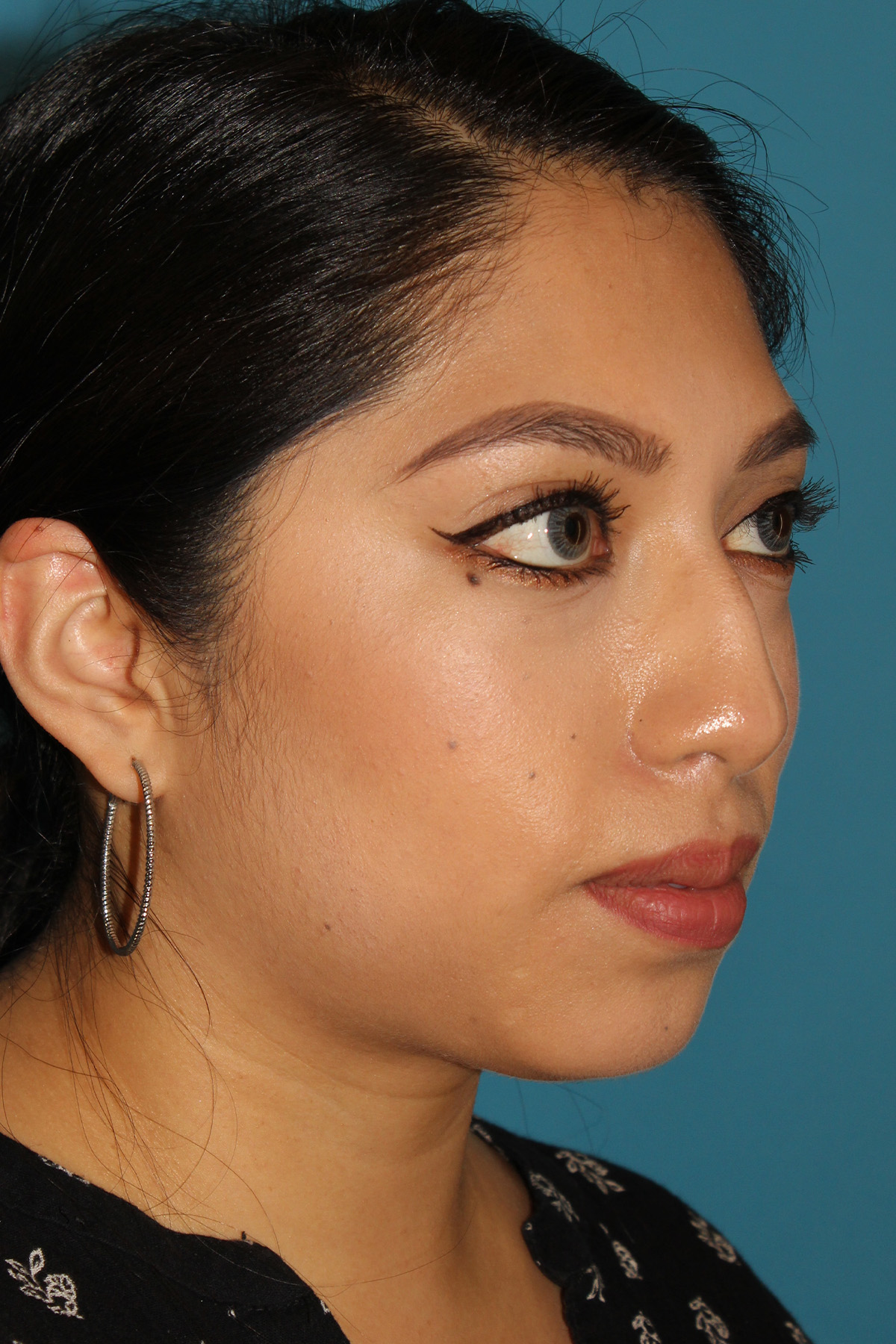 Chin Implant Before & After Patient #1670