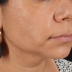 Facelift Before & After Patient #3555