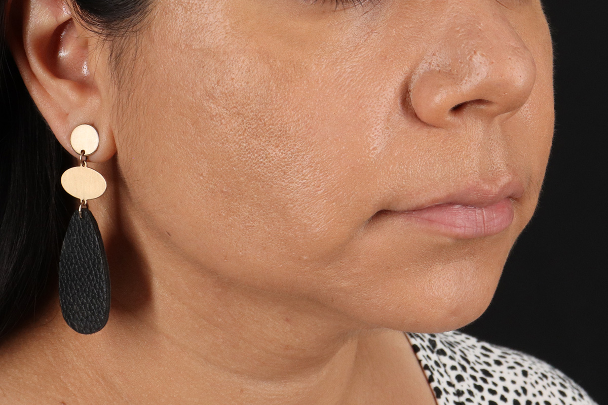 Facelift Before & After Patient #3555
