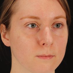 Rhinoplasty Before & After Patient #3280