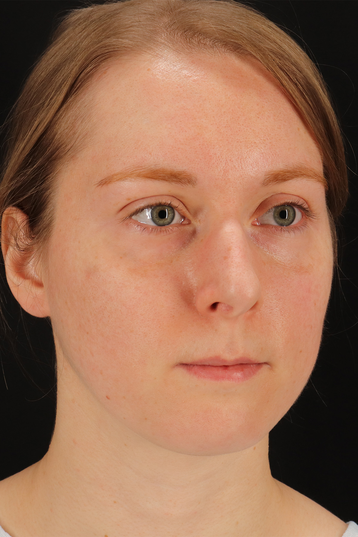 Rhinoplasty Before & After Patient #3280