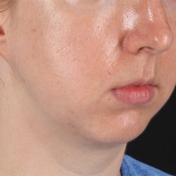 Chin Implant Before & After Patient #1562