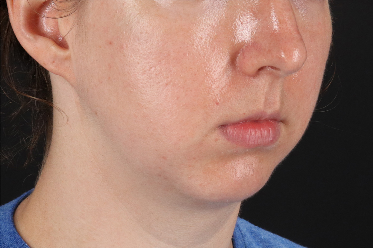 Chin Implant Before & After Patient #1562