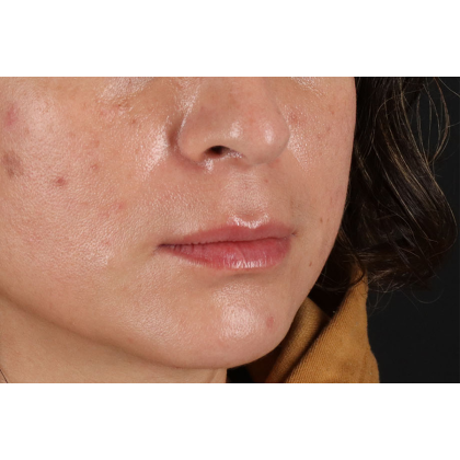 Lip Lift Before & After Patient #2166