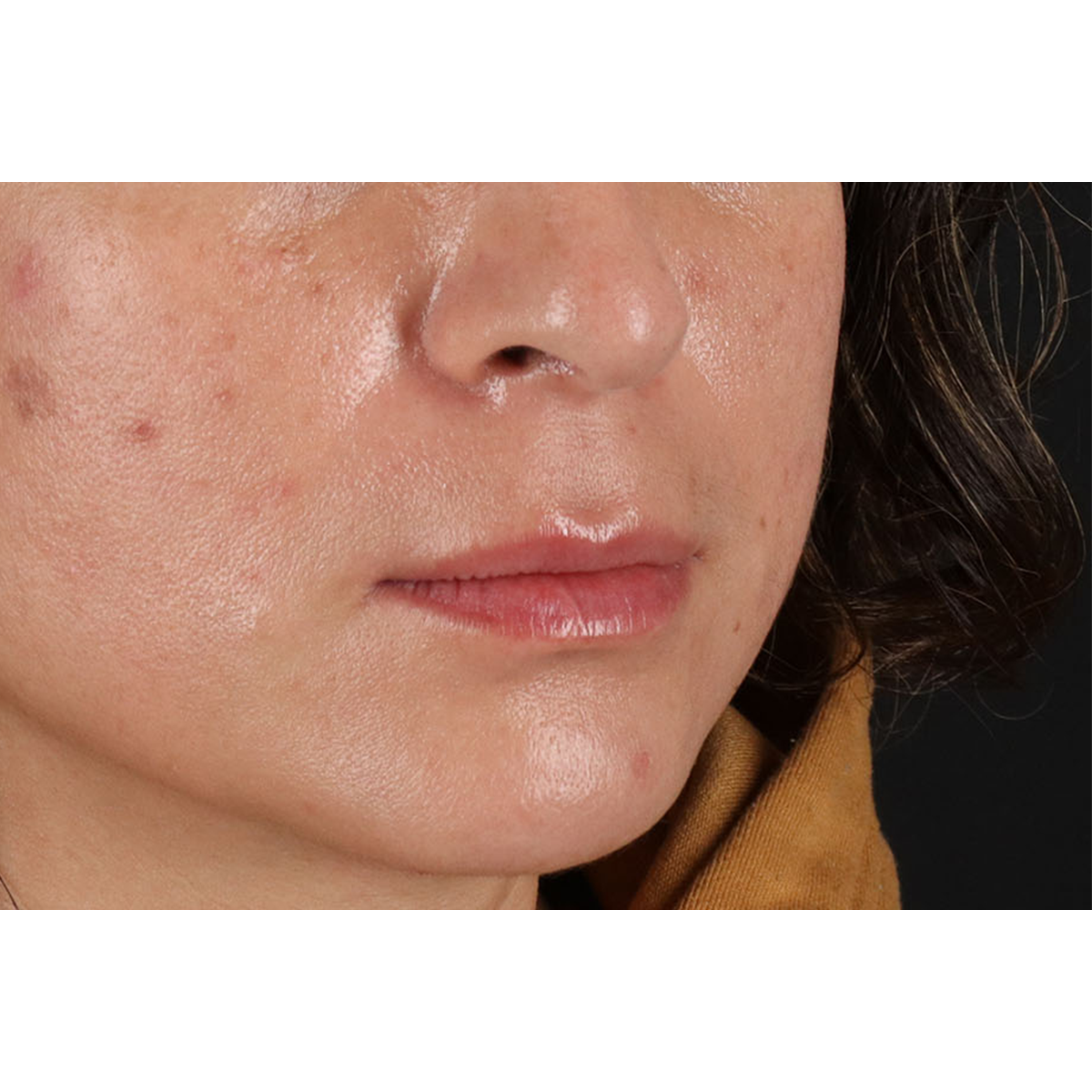 Lip Lift Before & After Patient #2166