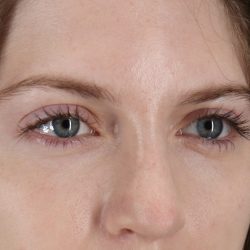 Browlift Before & After Patient #1319