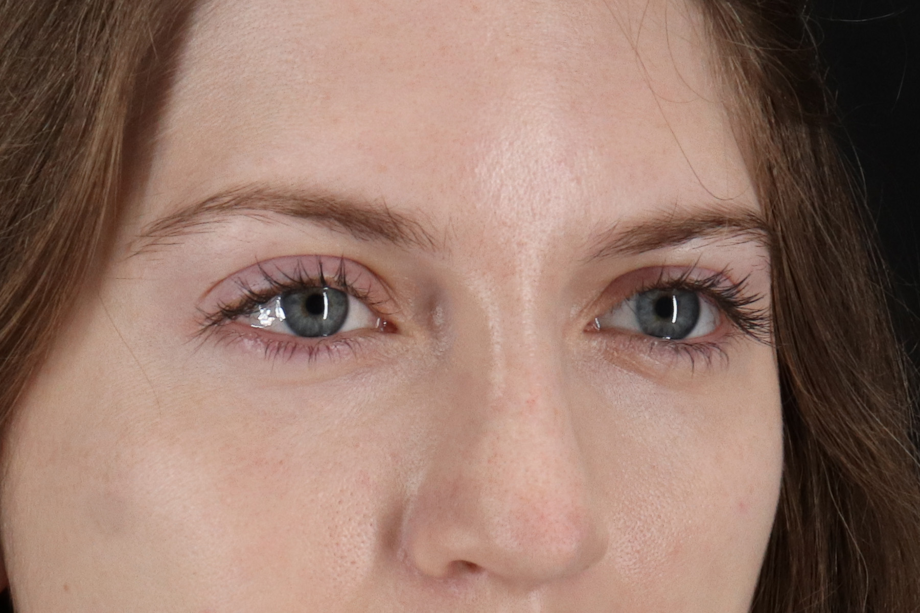 Browlift Before & After Patient #1319