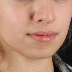 Chin Implant Before & After Patient #1573