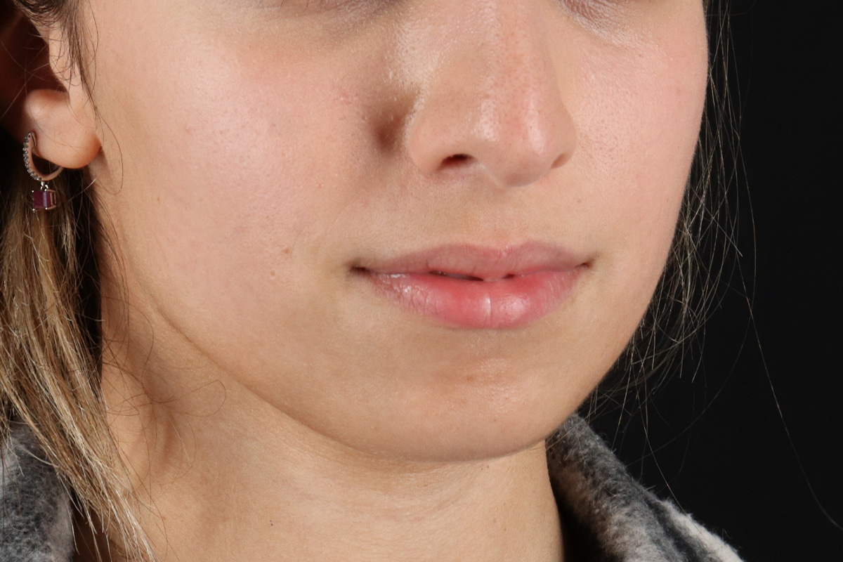 Chin Implant Before & After Patient #1573