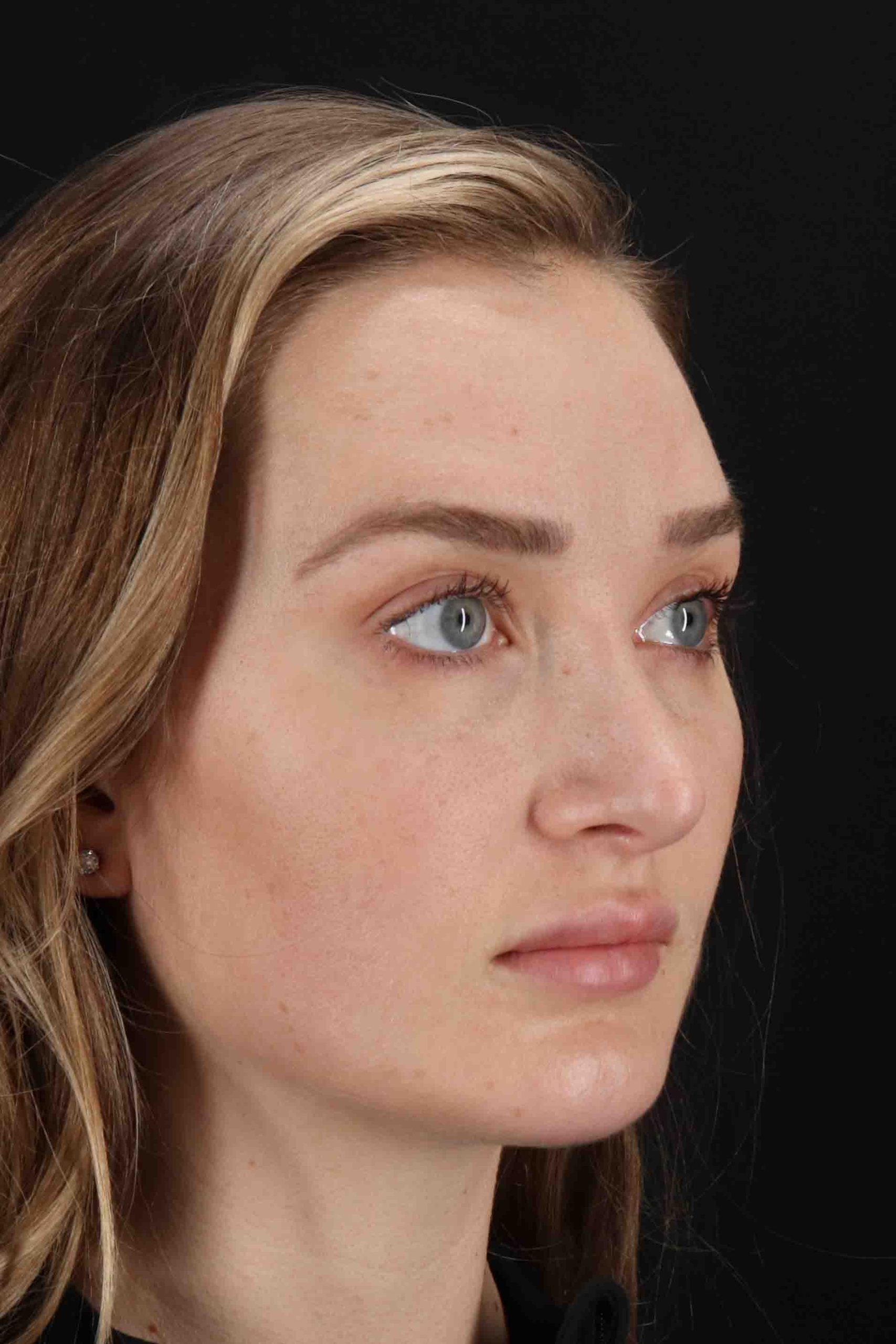 Browlift Before & After Patient #1297